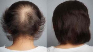 Alopecia_Areata_Treatments