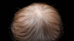 Why can i see my scalp through my hair